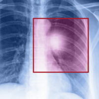 Lung cancer – Types, symptoms, and causes